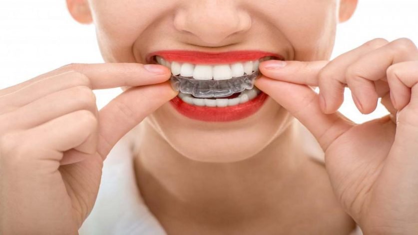 what-more-do-you-need-to-know-about-invisalign