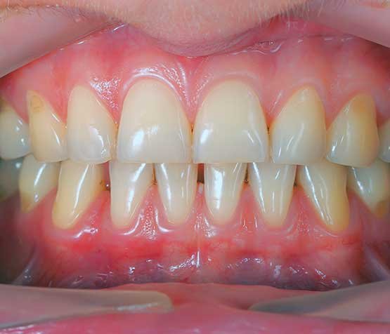 Recognizing Periodontitis Symptoms